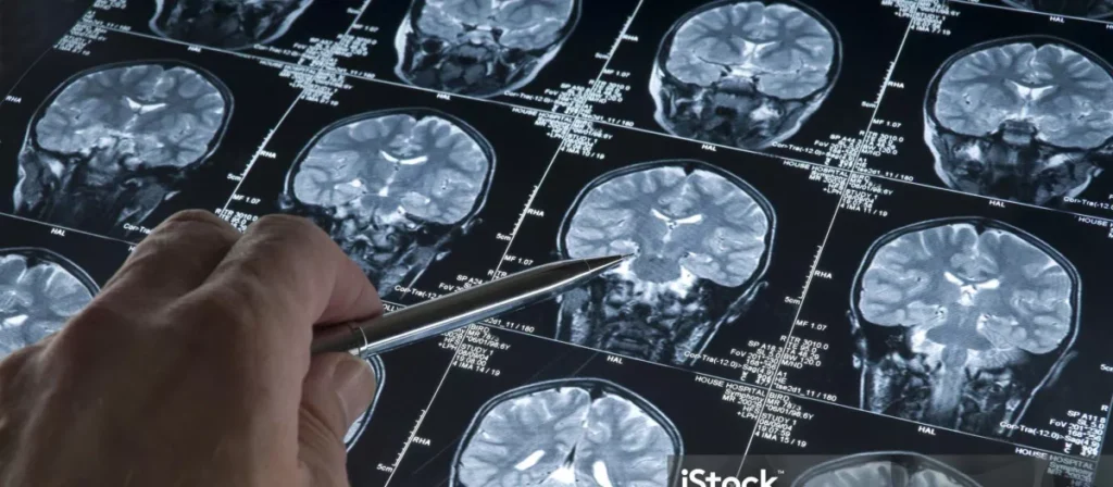 A Spanish Research Project Could Redefine Everything We Know About the Early Stages of Alzheimer’s Disease